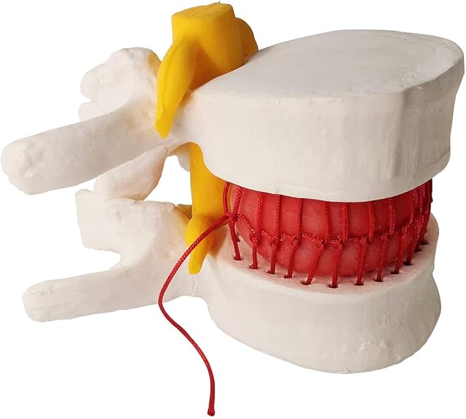 EVOTECH SCIENTIFIC Human Herniated Disc Model, Anatomical Herniated Lumbar Vertebrae Disc Prolapse Model for Medical Teaching Learning Education Display Tool 5 Pack