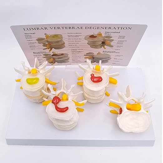 Human Skeleton Intervertebral Disc Herniation Model, 4 Stages of Lumbar Spine Disease Model, Spine Osteoporosis 4-Stage Disease Model for Learning and Education.