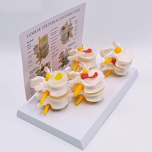 Human Skeleton Intervertebral Disc Herniation Model, 4 Stages of Lumbar Spine Disease Model, Spine Osteoporosis 4-Stage Disease Model for Learning and Education.