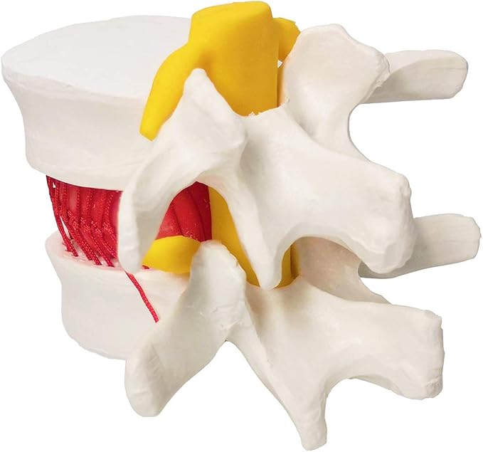 Human Herniated Disc Model, Anatomical Herniated Lumbar Vertebrae Disc Prolapse Model for Medical Teaching Learning, Education Display Tooling, Student Learning Education Display Tool 3 Pack