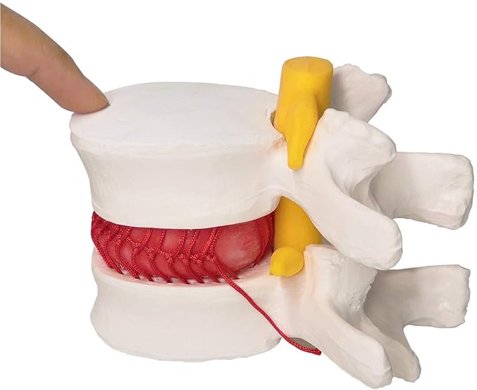Human Herniated Disc Model, Anatomical Herniated Lumbar Vertebrae Disc Prolapse Model for Medical Teaching Learning, Education Display Tooling, Student Learning Education Display Tool 3 Pack