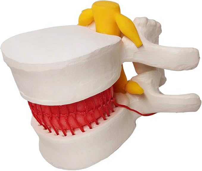 Human Herniated Disc Model, Anatomical Herniated Lumbar Vertebrae Disc Prolapse Model for Medical Teaching Learning, Education Display Tooling, Student Learning Education Display Tool 3 Pack