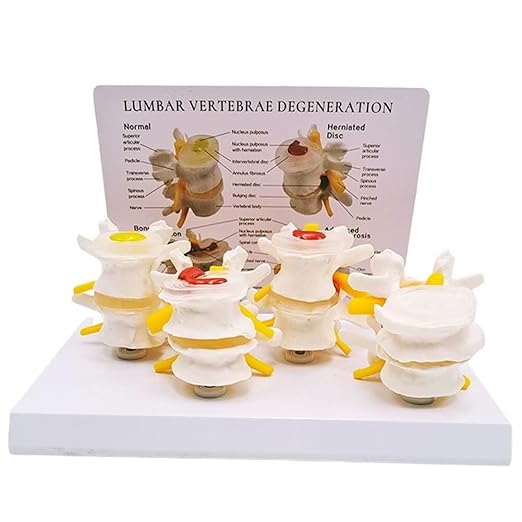 Human Skeleton Intervertebral Disc Herniation Model, 4 Stages of Lumbar Spine Disease Model, Spine Osteoporosis 4-Stage Disease Model for Learning and Education.