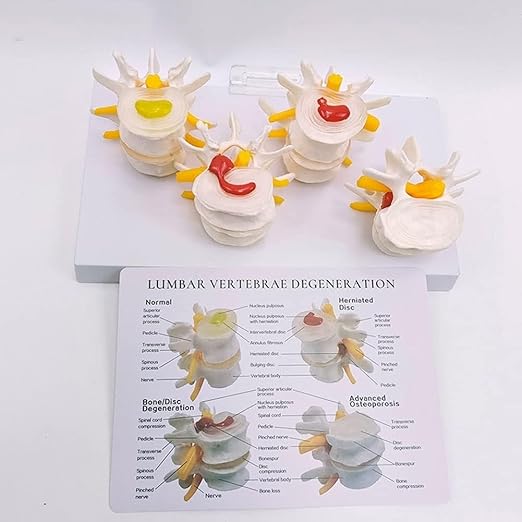 Human Skeleton Intervertebral Disc Herniation Model, 4 Stages of Lumbar Spine Disease Model, Spine Osteoporosis 4-Stage Disease Model for Learning and Education.