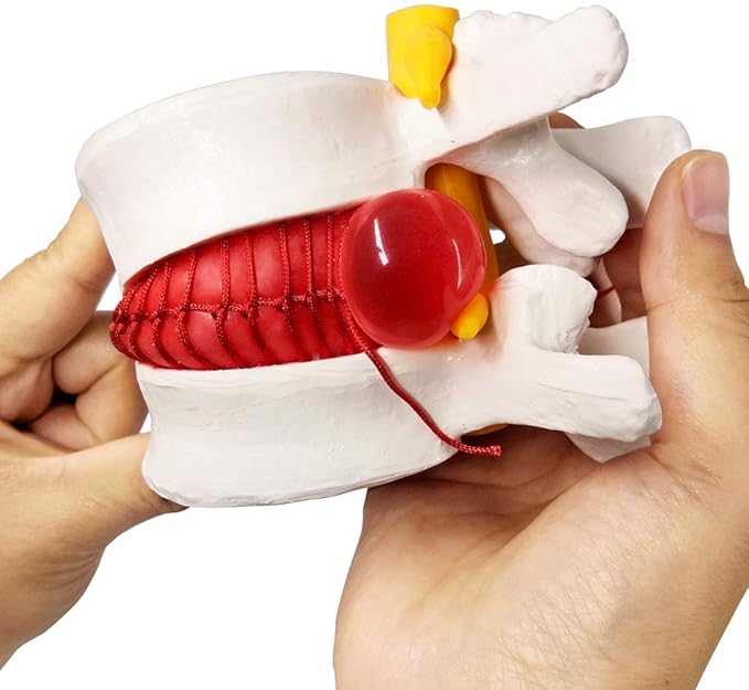 EVOTECH SCIENTIFIC Human Herniated Disc Model, Anatomical Herniated Lumbar Vertebrae Disc Prolapse Model for Medical Teaching Learning Education Display Tool